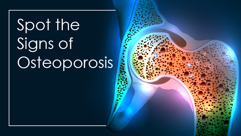 Learn How to Spot Signs of Osteoporosis