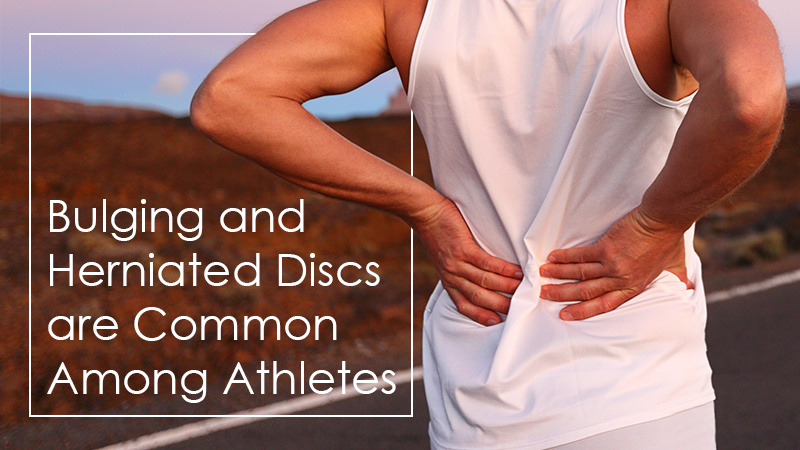 Bulging and Herniated Discs are Common Among Athletes